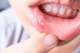 How to Get Rid of Canker Sores 