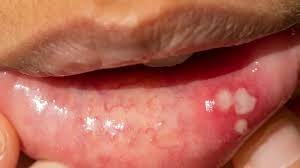 Common Causes of Canker Sores