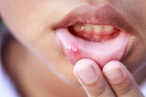 How to Get Rid of Canker Sores